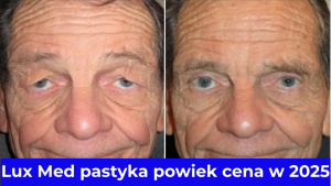 Lux Med pastyka powiek cena w 2025